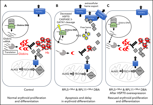 Summary of the unbalanced globin/heme equilibrium in DBA and the rescue of erythroid proliferation and differentiation by overexpression of HSP70.98 (A) During normal erythropoiesis, globin chains and heme are stoichiometrically expressed to produce Hb with no excess heme. (B) In DBA-affected patients who carry a mutation in the RPL5 or RPL11 gene, there is disequilibrium between globin and heme synthesis, resulting in excess free heme in erythroid cells. The excess free heme results in increased reactive oxygen species (ROS) production, contributing to cell death in DBA. (C) Overexpression of HSP70 rescues the DBA phenotype by protecting GATA1 and restoring globin/heme balance and thereby rescuing the erythroid proliferation and differentiation by decreasing apoptosis and erythroid cell death.