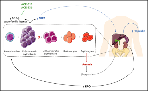 Schematic representation of the pathogenic mechanisms of CDAII at the systemic level. The pathogenic mechanism of CDAII at a systemic level, highlighting the role of erythroferrone (ERFE) in the interplay between the bone marrow and hepatic compartments. At the bone marrow level, block of erythroid maturation results in accumulation of erythroblasts that secrete ERFE. The increased levels of ERFE are responsible for the suppression of Hamp expression, which codes for hepcidin, and this can result in liver iron overload. EPO, erythropoietin; TGF-β, transforming growth factor-β.