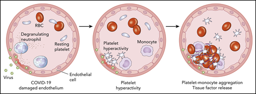 Schematic cross-section of a blood vessel depicting COVID-19–associated endothelial damage (left panel). At the site of endothelial injury, platelets become activated and aggregate (middle panel). These hyperactive platelets activate monocytes, leading to release of tissue factor, the principle regulator of the coagulation cascade (right panel). RBC, red blood cell.