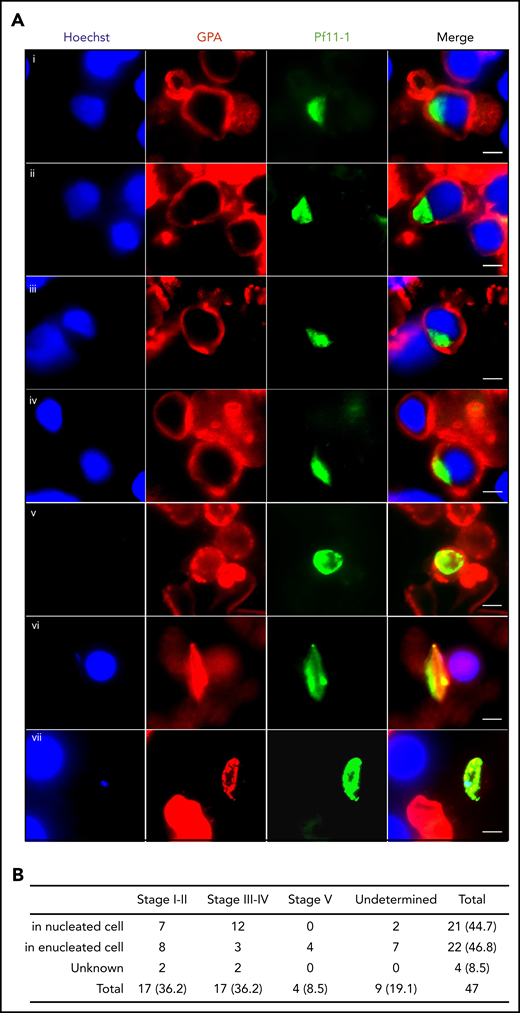 In vivo imaging of gametocytes within erythroblasts. (A) Immunofluorescence analysis of gametocyte-infected erythroblasts on methanol-fixed bone marrow smears from a P falciparum–infected patient. Gametocytes were stained with anti–Pf11-1 antibody (green), and erythroblasts were stained with anti-GPA labeling the erythroid membrane (red). DNA is stained with Hoechst 33342 (blue). (i-ii) Stage I-II gametocyte inside erythroblast. (iii-iv) Stage III-IV gametocyte inside erythroblast. (v) Stage I-II gametocyte inside reticulocyte or erythrocyte. (vi) Stage III-IV gametocyte inside reticulocyte or erythrocyte. (vii) Stage V gametocyte inside reticulocyte or erythrocyte. Gametocyte stages were evaluated based on the size and the shape of P11-1+ cells. Scale bars, 5 μm. (B) Quantification of P11-1+ cells in 3 bone marrow smears from the same patient. The absolute numbers of observed cells are indicated, with the percentages in parentheses.
