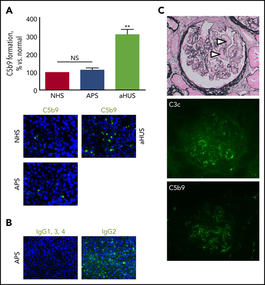 Patients with APS and microvascular thrombosis identified by kidney biopsy have normal ex vivo complement activation and lack significant in vivo complement deposits. (A) Ex vivo C5b9 formation on the perturbed endothelium did not differ between patients with APS (n = 15) and normal human serum (NHS), whereas serum from patients with primary aHUS and a pathogenic gain-of-function variant in C3 induced unrestrained complement activation (n = 5); original magnification ×400. **P < .01; NS not significant. (B) IgG2, but not the other subclasses, bound to the endothelium when incubated with serum from triple-positive patients (2 of 2); original magnification ×200. (C) Microvascular thrombosis on kidney biopsy (arrowheads). Scant deposits of C3c (7 of 17) and/or C5b9 (2 of 17) along segments of the glomerular capillary wall were uncommon. Original magnification ×400.