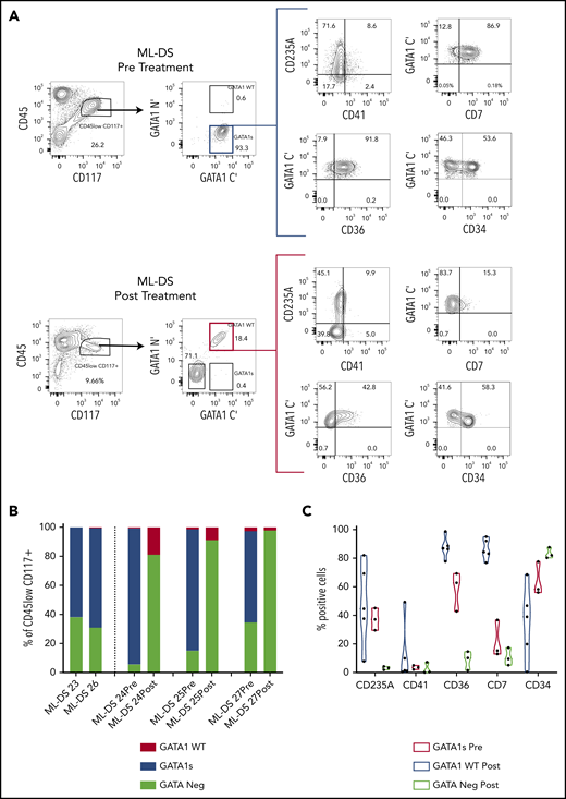 Intracellular flow detection of GATA1s+ cells is highly sensitive and can be used to measure MRD in ML-DS. (A) Representative flow cytometry panels of ML-DS samples before (top) and after chemotherapy (bottom) in which additional markers previously described as aberrant (CD235A, CD41, CD7, CD36, and CD34) were examined in GATA1s+ cells (blue gate) and GATA1WT (red gate). (B) Bar graph showing the proportion of GATA1s+ (blue), GATA1WT (red) and GATA1 negative (light green) cells within the CD45lowCD117+ gate in 5 prechemotherapy and 3 postchemotherapy ML-DS samples. (C) Violin plots showing the percent of cells positive for CD235A, CD41, CD36, CD34, and CD7 in GATA1s+ cells before chemotherapy (blue), GATA1WT after chemotherapy (red), and GATA1− cells after chemotherapy (light green). (D) Flow cytometry plots of dual immunostaining with antibodies against the N′ and C′ termini of GATA1 in: OCI-AML3 cells (left), a GATA1 negative cell line; K562 cells (middle), a cell line expressing both GATA1fl and GATA1s; and CMK (right), a GATA1s+ cell line derived from a ML-DS patient. (E) Schematic representation of a serial dilution of CMK cells. A total of 500 000 CMK cells were serially diluted 11 times into OCI-AML3/K562 cells mix and iFC performed on tubes 1, 3, 5, 7, 8, 9, 10, and 11. Expected frequency of CMK cells is shown below each tube that was tested by iFC. (F) Representative flow cytometry panels of serially diluted GATA1s+ CMK cells (blue gate) in a cell mixture of CMK/OCI-AML3/K562. A total of 500 000 live events were recorded per tube but only a fraction of events is shown for clarity. Each gate contained more than 300 events. Percent of cells in the blue gate from 2 replicates is shown. (G) Top, 3 flow cytometry plots showing the percentage of GATA1WT and GATA1s+ cells in the live CD45lowCD117+ cell compartment in 3 postchemotherapy ML-DS samples in which no GATA1s mutations were identify by NGS. Below, graph of the percentage of GATA1s+ cells live CD45lowCD117+ gate in the isotype controls (4 samples), DS neonates (7 samples), and 3 ML-DS postchemotherapy samples.