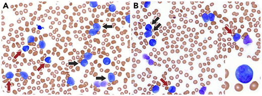 A 58-year-old man presented with a white blood cell count of 126 × 103/μL, hemoglobin of 10.7 g/dL, a platelet count of 45 × 103/μL, and a D-dimer of 12.01 μg/nL fractional excretion of urea. A peripheral smear revealed 97% blasts, demonstrating prominently cleaved nuclei with fine chromatin, prominent nucleoli, Auer rods, and occasional cup-like nuclei (panels A-B: black arrows, cleaved nuclei; red arrows, cup-like nuclei; Wright-Giemsa stain; original magnification ×400; inset, blast with Auer rod, original magnification ×400). Flow cytometry revealed abnormal myeloid blasts expressing myeloperoxidase, CD13, CD33, CD117, CD38, CD64, CD4, and lacking CD34, CD11B, and HLA-DR. Cytogenetics showed a normal 46,XY karyotype, and there was no evidence of promyelocytic leukemia/retinoic acid receptor α (PML-RARA) by fluorescence in situ hybridization (FISH) or real-time polymerase chain reaction. Next-generation sequencing revealed pathogenic variants in nucleophosmin 1 (NPM1; c.860_863dup), DNA methyltransferase 3A (DNMT3A; c.1054delA), isocitrate dehydrogenase 2 (IDH2; c.419G>A), and an FLT3 internal tandem duplication (ITD).