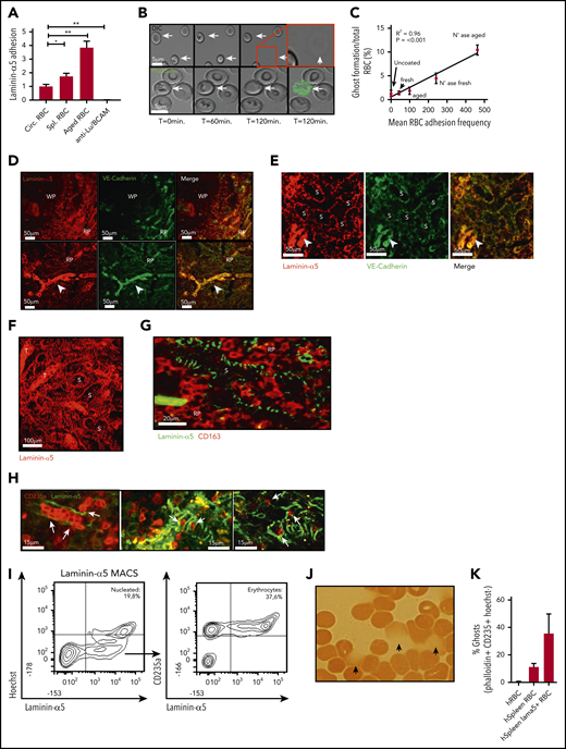Adhesion of senescent erythrocytes to laminin-α5 in the human spleen drives ghost formation. (A) Laminin-α5 flow assay using control, old, and spleen-derived erythrocytes. Anti-Lu/BCAM blocking antibody was used to assess whether adhesion to laminin-α5 was Lu/BCAM dependent (n = 4-7, mean ± SEM). (B) Representative flow assay confocal micrograph depicting erythrocytes that interact with laminin-α5 for extended durations at low shear stresses of 0.5 dyn/cm2. Erythrocyte shape abnormalities are observed after roughly 1 hour (T = 60 minutes, arrows), and ghost formation is observed after roughly 2 hours. The lower panel depicts a flow experiment in which phalloidin has been added to the flow medium. Upon ghost formation through hemolysis, the erythrocyte membrane becomes permeable, leading to intracellular F-actin staining by phalloidin. (C) Correlation between adhesion of fresh, control, and neuraminidase-treated erythrocytes to laminin-α5 and the rate at which ghost formation is observed. (D-G). Laminin-α5 localization with respect to the white pulp (WP), red pulp (RP), the RP sinus (S) CD163+ cells and trabeculae (T). Continuous VE-cadherin distribution (arrowhead) was observed on protruding veins but not within the sinuses. (H) A 2-photon micrograph showing laminin-α5 distribution in the splenic sinusoids of the RP and their interaction (white arrows) with erythrocytes (glycophorin-A, CD235a) up to 100 µm deep within an intact piece of human spleen. (I) Flow cytometric gating strategy and quantification of nucleated cells that interact with laminin-α5 (Hoechst+), erythrocytes (Hoechst−CD235a+), and other cells (Hoechst− CD235a−) from human spleen. (J) Hemoglobin content of laminin-α5 MACS-isolated erythrocytes was assessed by using benzidine staining. Hemoglobin leakage was observed as indicated by the arrows. (K) Quantification of laminin-α5 positive and negative erythrocyte ghosts within human spleen tissue. *P < .05; **P < .01 (mean ± SD).