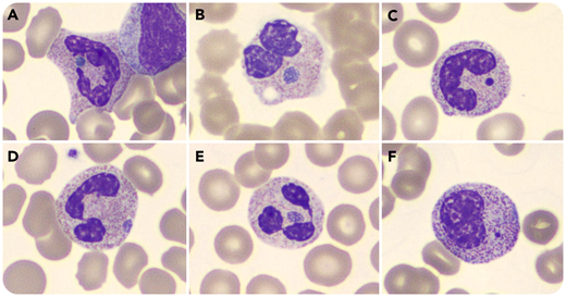 A 65-year-old woman underwent embolization of the left inferior epigastric artery. During this interventional radiology procedure, 2 detachable 2-mm coils were deployed surrounding gelfoam. Blood smear 36 hours later showed a round, blue neutrophilic inclusion likely representing engulfed gelfoam material (panel A; Wright stain). This inclusion was found in only a single neutrophil. For comparison, neutrophils containing morulae are shown from 3 other patients who tested positive by polymerase chain reaction for Ehrlichia ewingii and Ehrlichia canis (panel B; Wright stain) and Anaplasma phagocytophilum (panels D and E; Wright stain). In addition, panels C and F (Wright stain) contain detached nuclear remnants from other patients’ smears. The inclusion is a brighter blue in the patient who underwent gelfoam embolization. Her blood smear did not show Döhle bodies. Because she had been hospitalized for just over 3 months with complications from COVID-19, a tick bite was extremely unlikely. Furthermore, her blood smear did not show atypical lymphocytosis, and she was afebrile, in contrast to the other patients who had ehrlichiosis and anaplasmosis. Images are from Cellavision DM96 software which scans oil images of cells on blood smears (magnification for all panels, ×100).
