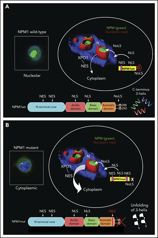 Nucleo-cytoplasmic shuttling of NPM1wt and NPM1 mutants. (A) Physiological NPM1wt shuttling. The bipartite NLS drives the nuclear import of NPM1wt. The C-terminal 3-helix NoLS dictates NPM1wt positioning within the nucleolus, whereas the 2 weak nuclear export signals (NESs) at the N terminus are responsible for its export from the nucleus to the cytoplasm (dashed arrow). Eventually, the nuclear import predominates over export so that almost all NPM1wt resides in the nucleolus. (B) Abnormal traffic of NPM1 mutants. Changes in tryptophans (W) 288 and 290 (or 290 alone), with consequent unfolding of the C-terminal triple-helix, abrogate the capability of the mutant to reside within the nucleolus. Furthermore, the insertion of a third NES motif at the C terminus markedly increases the export of the protein (thick arrow). Thus, the nuclear export predominates over the import, and the NPM1 mutant is delocalized in the cytoplasm. The 3-dimensional reconstruction of confocal images shown in the circles has been adapted from Falini et al.7 Nuclei are stained with 4′,6-diamidino-2-phenylindole, while the nucleoli are double-stained for NPM1 and nucleolin. Boxes show OCI-AML3 cells engineered to express either endogenous NPM1wt or NPM1 mutant fused to GFP. Nuclei are stained with Hoechst 33342.