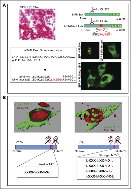NPM1 mutants are "born to be exported." (A) A new NPM1 mutation at exon 5. IHC highlights leukemic blasts with cytoplasmic NPM1 (arrows) and normal erythroid cells with a nucleus-restricted expression of NPM1 (asterisk) (bone marrow biopsy, immune-alkaline phosphatase staining using anti–N terminus antibody, clone 376; original magnification ×400) (upper left panel). Sequence of exon 12 of NPM1 was wild-type (data not shown) (lower left panel). Targeted sequencing of the other NPM1 gene exons revealed a new mutation at exon 5, consisting of an in-frame 27-nucleotide insertion and leading to a mutant protein that is 9 aa (shown in red) longer than the wild-type (NPM1wt). Analysis of the new protein sequence predicted a newly acquired NES. Schematic representations of the new mutant protein (NPM1mut-Ex5) compared with wild-type (NPM1wt) (upper right panel). Both are recognized by the anti–N terminus monoclonal antibody (clone 376). The C terminus of the new mutant is unchanged. Cloning of the new mutant NPM1 gene sequence into a GFP-containing vector and expression in NIH3T3 cells confirmed the cytoplasmic localization of the NPM1 mutant protein (GFP-NPM1mut-Ex5), similarly to NPM1 mutant A (GFP-NPM1mutA) (lower right panel). Nucleolar localization of NPM1wt is shown as control (GFP-NPM1wt) (fluorescence microscopy, original magnification ×400). (B) Tuning of NES motif strength. When the capability of NPM1 mutant to bind the nucleolus is completely abrogated (loss of W288 and W290), a weaker C-terminal NES is inserted. When the capability of NPM1 mutant to bind the nucleolus is partially retained (loss of W290 alone), a stronger C-terminal NES motif is inserted. The 3-dimensional reconstruction in the upper left panel is from Falini et al.7