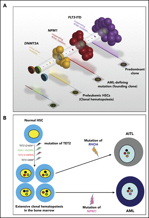 NPM1 and other mutations cooperate to promote AML. (A) AML with the triple-mutated (DNMT3A/NPM1/FLT3-ITD) genotype is observed in patients and is associated with a particularly poor outcome. DNMT3A mutations are early genetic events that are responsible for the generation of a clonal hematopoiesis. NPM1 mutations are disease-defining genetic lesions that are gatekeepers for AML, whereas FLT3-ITD mutations are late events. Courtesy of Timothy Ley. (B) Hypothetical steps in the sequential development of angioimmunoblastic T-cell lymphoma (AITL) (RHOA mutation; orange) followed by NPM1-mutated AML (NPM1 mutation; pink) in a 45-year-old man. The 2 neoplasms arose from high-risk clonal hematopoiesis in the bone marrow promoted by multiple TET2 and ASXL1 mutations.49 The TET2 Q1654* mutation (black) was present in virtually all bone marrow cells (variant allele frequency, 49.3%). The other mutations (TET2 E1089Kfs, red; TET2 Q888, gray; and ASXL1 E635Rfs, green) showing lower allele frequencies likely occurred later as subclonal events.