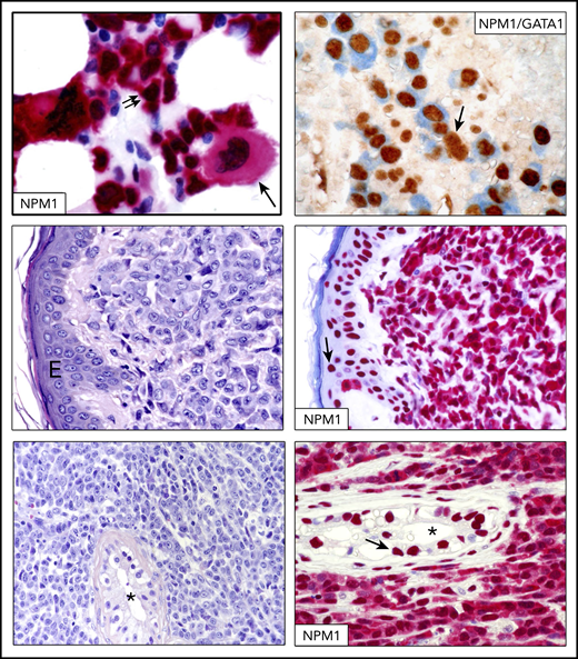 IHC in NPM1-mutated AML and myeloid sarcoma.NPM1-mutated AML with multilineage dysplasia showing infiltration by blasts (double arrows) and a monolobated megakaryocyte (single arrow) (bone marrow biopsy, immune-alkaline phosphatase staining, original magnification ×400) (top left panel). Reprinted from Pasqualucci et al.77 Another case of NPM1-mutated AML with multilineage dysplasia double stained for NPM1 (blue) and GATA1 (brown) (top right panel). Numerous erythroid leukemic cells (GATA1 nuclear brown/NPM1 cytoplasmic blue) are present. The arrow indicates a residual normal erythroid cell (original magnification ×400; double staining with immune-alkaline phosphatase/immunoperoxidase). Skin biopsy, showing dermal infiltration by leukemic cells (original magnification ×400; hematoxylin and eosin stain) (middle left panel). Leukemic cells from the same patient show aberrant cytoplasmic expression of NPM1, confirming the diagnosis of NPM1-mutated skin myeloid sarcoma (middle right panel). Normal cells of the overlying epidermis show nucleus-restricted expression of NPM1 (arrow) (original magnification ×400; immune-alkaline phosphatase staining). Testicular biopsy showing massive infiltration by leukemic cells and a residual seminiferous tubule (*) (original magnification ×400; hematoxylin and eosin stain) (bottom left panel). Leukemic cells from the same patient show aberrant cytoplasmic expression of NPM1, confirming a diagnosis of testicular myeloid sarcoma (bottom right panel). Cells of a normal residual seminiferous tubule (*) show nuclear expression of NPM1 (arrow) (original magnification ×400; immune-alkaline phosphatase staining). E, epidermis.