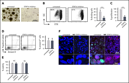 STAT6 regulates proliferation but not survival of malignant lymphocyte in MF and SS patient samples. Peripheral blood SS CD4+ T cells were cultured for 5 days with/without AS1517499. (A) Representative images from the cell culture conditions indicated on day +5. (B) Cell proliferation by CSFE assay. The cellular division capacity was determined by flow cytometry. Gates are set in the dividing cell population. A representative experiment and the mean percentage of divided (CFSElow) cells ± standard deviation (SD) from 5 SS patients are shown. (C) Cell metabolic activity was measured by MTT assay. Results are expressed as percent change of absorbance from untreated control cells, which is set at 100% and represents mean values of triplicate measurements from 11 independent samples. Data are shown as mean ± SD compared with untreated cells. (D) Annexin V and propidium iodide (PI) staining followed by flow cytometry after 48 hours of treatment. Annexin V-positive, PI-negative cells were considered apoptotic. Representative examples and mean percentage of apoptotic cells from 5 SS patients are shown. (E) Cell viability determined by Cellometer Auto 2000 Cell Viability Counter. (F) Representative examples of double-color immunofluorescence microscopy for Ki67/TOX from ex vivo skin explants (MF, n = 5; NS, n = 5) cultured for 5 days with/without STAT6 inhibition as indicated, ×1000. Statistics in panels B-E by Student t test.