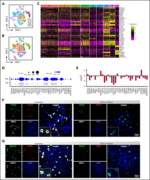 STAT6 regulates gene expression of TAMs in the TME of advanced stage MF. (A) Transcriptomes of macrophages by scRNAseq from individual MF skin tumors (n = 3, 2312 cells) and NS samples (n = 4, 322 cells), color-coded by subject, (B) revealing 9 discrete Louvain clusters. (C) Gene expression from the 9 discrete Louvain clusters in panel B, showing examples of highly significant DEGs in each of the clusters. Cluster numbers are indicated at the top. Each column represents a cell. (D) Dot-plot showing the proportion of cells and the scaled average gene differential expression of the macrophage tumor-associated genes selected in panel C. (E) Bar plot showing the differential expression of the genes selected in panel C after STAT6 inhibition for 48 hours of MF skin tumors (Log2FC > ± 0.58 and P < .05). (F) Three-color immunofluorescence microscopy showing coexpression of CD163, MRC1, and CCL17 or CTSC, in advanced-stage MF skin explants (n = 5) cultured for 5 days with/without AS1517499. Representative examples are shown at ×600, inset double the scale.