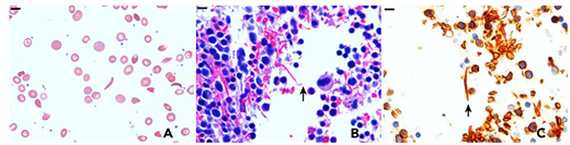 A 32-year-old woman with sickle cell disease (SCD) presented with fever, chills, and chest pain. Laboratory results showed leukocytosis with bandemia, and her baseline hemoglobin values. Blood cultures were positive for α hemolytic Streptococcus and Actinomyces. Given the patient’s poor dentition and a left maxillary sinus opacity on computed tomography scan, there was suspicion for an odontogenic/sinus infection. She underwent dental extraction, abscess drainage, and sinus debridement. The sinus debridement contents showed erythroid-predominant hematopoiesis and sickled red blood cells (sRBCs).