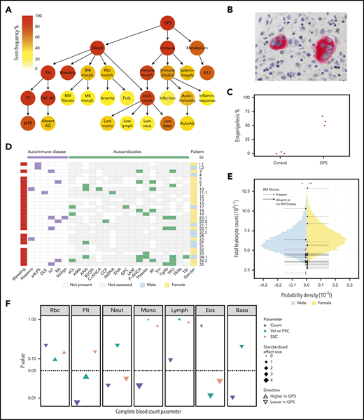 Novel clinical phenotypes. (A) Summary HPO tree, showing the 3 most frequent HPO organ systems represented in the 47 patients with GPS: Blood (“Abnormality of blood and blood-forming tissues”), Immune (“Abnormality of the immune system”), and Metabolism (“Abnormality of metabolism/homeostasis”). HPO terms affecting ≥8 patients are shown except terms associated with “Bleeding,” which are displayed in supplemental Figure 2.1. HPO term labels: Plt, “Abnormal thrombocyte morphology”; Bleeding, “Abnormal bleeding”; BM morph., “Abnormality of bone marrow cell morphology”; Rbc morph., “Abnormal erythrocyte morphology”; Immune morph., “Abnormal immune system morphology”; Immune physiol., “Abnormality of immune system physiology”; Splenomegaly, “Splenomegaly”; B12, “Abnormal vitamin B12 level”; TP, “Thrombocytopenia”; Def. AG, “Abnormal number of alpha granules”; BM fibrosis, “Myelofibrosis”; MK morph., “Abnormal megakaryocyte morphology”; Anemia, “Anemia”; Poik., “Poikilocytosis”; Leuk. count, “Abnormal leukocyte count”; Infection, “Recurrent infections”; Autoimmunity, “Autoimmunity”; Inflamm. response, “Increased inflammatory response”; MTP, “Macrothrombocytopenia”; Absent AG, “Absence of alpha granules”; Low mono, “Monocytopenia”; Low lymph, “Lymphopenia”; Low neut, “Neutropenia”; Low baso, “Decreased basophil count”; AutoAb, “Autoimmune antibody positivity.” (B) BM trephine image with CD61 stain (1000×) of patient ID 20.3, which shows neutrophil emperipolesis by 2 MKs. (C) Dot plot showing percentage of MKs with neutrophil emperipolesis in 3 patients with GPS (patient IDs 18, 33, and 34.1) (supplemental Figure 2.2 presents representative BM trephine images) and 3 control subjects. (D) Representation of autoimmune disease, results of autoantibody tests, and presence of bleeding symptoms in 29 patients with GPS (labeled according to patient ID) in whom autoantibody tests were performed. Autoantibodies tested in at least 3 patients are included (listed per order in graphic): aALPS, atypical autoimmune lymphoproliferative syndrome; DLE, discoid lupus erythematosus; HT, Hashimoto’s thyroiditis; RA, rheumatoid arthritis; and autoantibodies against: aCL, cardiolipin; AMA, mitochondria; ANA, nuclear; B2GPI, beta2-glycoprotein I; C-ANCA, neutrophil cytoplasmic; CCP, cyclic citrullinated peptide; dsDNA, double-stranded DNA; ENA, extractable nuclear antigen; GPC, gastric parietal cell; LKM, liver–kidney microsome; P-ANCA, neutrophil perinuclear; RF, rheumatoid factor; Sm, spliceosomal; TgAb, thyroglobulin; TPO, thyroperoxidase; TRAb, thyroid-stimulating hormone receptor; TSI, thyroid stimulating immunoglobulin. (E) Histogram showing the total leukocyte count of 45 032 blood donors in the INTERVAL study43 stratified according to sex, upon which the results of the patients with GPS are represented by arrows. The median total leukocyte count of both male and female patients with GPS was significantly (P = 3 × 10−3 and 4 × 10−4, respectively) lower than INTERVAL participants using a one-sample Wilcoxon signed-rank test, as represented by * and **. (F) CBC results for 5 patients with GPS vs 5 control subjects. The data point for each cell type and CBC parameter shows the absolute standardized effect size and directionality. On the y-axis (log10 scale), the P value (Mann-Whitney U test) is shown; the horizontal dotted line represents P < .05. Volume (Vol) or forward scatter (FSC) refers to the following measurements: mean cell volume (MCV) for red blood cells (Rbc), platelet mean frequent volume (P-MFV) for platelets (Plt); FSC for neutrophils (Neut), monocytes (Mono), lymphocytes (Lymph), eosinophils (Eos), and basophils (Baso). SSC was available for all parameters except basophils and reflects the complexity of cellular contents, including granularity.