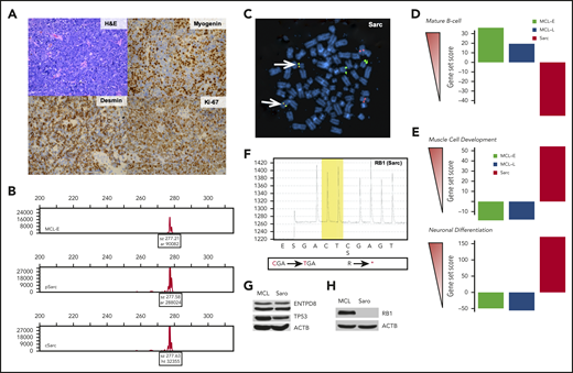 Immunophenotypic, cytogenetic, gene expression, and mutational profiling of Sarc (sarcoma) cells. (A) Morphology (hematoxylin and eosin stain) and immunohistologically detected expression of markers indicative of muscle differentiation (myogenin and desmin). Proliferative rate of the tumor was determined by expression of Ki-67. (B) Clonal rearrangement of immunoglobulin heavy chain (IGH) detected in primary (p) and cultured (c) Sarc cells matching the clonal IGH peak present in the control MCL-E cells. (C) IGH-CCND1 gene fusion (yellowish spots pointed to by arrows) detected in Sarc cells by fluorescence in situ hybridization (FISH). (D) Expression of genes associated with mature B-cell differentiation stage by the depicted cell populations identified by the genomic-scale RNA-Seq analysis. (E) Expression of genes associated with striated muscle (upper) or neuronal (lower) differentiation in the same cell populations detected also by RNA-Seq. (F) Whole-exome sequencing-identified nonsense mutation of RB1 gene confirmed in Sarc cells by pyrosequencing. (G) Loss of expression of the RB1 protein by Sarc cells with MCL-RL cells4 serving as positive control. (H) Expression of the ENTPD8 and TP53 proteins by Sarc cells with MCL-RL cell line4 serving as positive control.