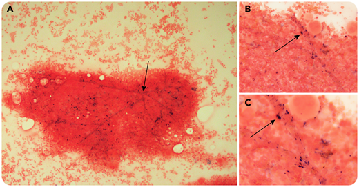 An 80-year-old woman with a 2-year history of myelodysplastic syndrome/myeloproliferative neoplasm with ring sideroblasts and thrombocytosis, SF3B1 positive, was referred to our clinic for a second opinion regarding worsening transfusion dependency of red blood cells (every 1-2 weeks for a maximal hemoglobin count of 60 g/L). Due to the multiple transfusions, the patient exhibited iron overload, with a ferritin level of 694 μg/L despite iron chelation (deferasirox). The patient underwent a bone marrow examination before initiation of luspatercept. Iron staining (Prussian blue) of the bone marrow showed, in addition to the usual signs of iron overload, a probable endothelial deposition of the iron in the vessels (see arrows in panels A-C; panel A, 10× magnification; panel B, 50× magnification; panel C, 100× magnification).