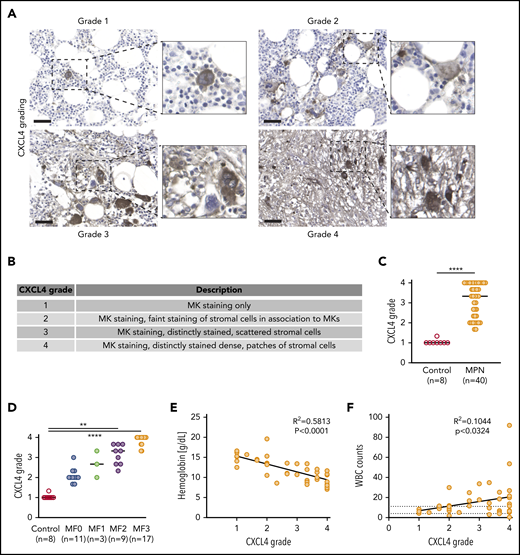 The spatial expression of CXCL4 marks the progression of BM fibrosis in patients. (A) Representative images of CXCL4 grading (1-4) in human BM biopsy samples. Original magnification ×20. Scale bar, 50 μm. (B) Description of the main features of CXCL4 grading scale in human BM biopsy samples. (C) Quantification of the CXCL4 grade in MPN and controls. Data shown as median; Mann-Whitney U test. (D) Quantification of the CXCL4 grade compared with myelofibrosis grade (reticulin staining). Kruskal-Wallis test followed by Dunn’s post hoc test. (E) Comparison of hemoglobin levels vs CXCL4 grade. (F) Comparison of WBCs vs CXCL4 grade. Controls, n = 8; MPN, n = 40. Patient characteristics are shown in supplemental Tables 1 and 2. **P < .01, ****P < .0001.