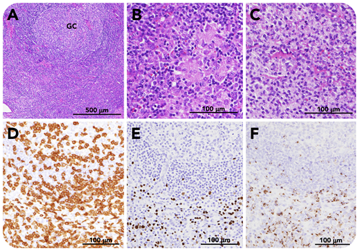 A 47-year-old man presented with persistent fever and fatigue. Laboratory findings included thrombocytopenia, hepatic dysfunction, polyclonal hypergammaglobulinemia, and evidence of systemic inflammation. Computed tomography scanning demonstrated anasarca, hepatosplenomegaly, and generalized lymphadenopathy. Viral screening revealed positive Epstein-Barr virus (EBV) capsid antigen (VCA) immunoglobulin G (IgG; 1:20 480); nuclear antigen antibody (1:40) and early antigen-diffuse/restricted type IgG (1:1280); and negative VCA-IgM. EBV-DNA of peripheral blood mononuclear cells was also positive (11 000 copies per 106 cells). Axial lymph node biopsy shows preserved nodal structure, paracortical hyperplasia, and an enlarged lymphoid follicle (panel A, hematoxylin and eosin stain; GC, germinal center) with epithelioid granuloma (panel B, hematoxylin and eosin stain) and monocytoid B-cell infiltration (panel C, hematoxylin and eosin stain). CD3+ T cells are present in the interfollicular zone (panel D, CD3 stain), where EBV-encoded small RNA (EBER)-positive cells are distributed (panel E, EBER in situ hybridization (ISH)). T cells are positive for granzyme B (panel F, granzyme B stain) (scale bars: panel A, 500 μm; panels B-F, 100 μm). No cells expressed EBV latent membrane protein or EBNA-2. The patient was diagnosed with chronic active EBV infection (CAEBV). Cyclophosphamide, doxorubicin, vincristine, etoposide, and prednisone (CHOEP) chemotherapy was given followed by allogeneic hematopoietic stem cell transplantation.