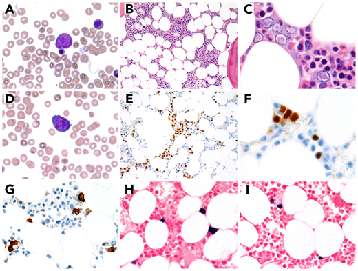 A 55-year-old man with a history of κ light-chain plasma cell myeloma, in remission and undergoing therapy (lenalidomide, bortezomib, dexamethasone, and zoledronic acid), presented for routine bone marrow follow-up. The complete blood count showed normal hemoglobin/hematocrit (13.3 g/dL; 40.0%) with leukopenia (2860 white blood cells per microliter) and thrombocytopenia (59 000 platelets per microliter). Bone marrow examination showed large left-shifted erythroid precursors with prominent intranuclear inclusions on aspirate (panels A,D; Wright stain; original magnification ×1000) and biopsy (panels B-C; hematoxylin and eosin stain; original magnification ×200 and ×500, respectively). Parvovirus immunohistochemistry was positive (panels E-F; original magnification ×200 and ×500, respectively). No significant morphologic abnormalities were seen in the granulocytic or megakaryocytic lineages. Subsequent polymerase chain reaction analysis was positive for parvovirus B19. CD138 immunohistochemical-stained <5% plasma cells (panel G; original magnification ×500) with polytypic κ and λ in-situ hybridization studies (panels H-I; original magnification ×500). Concurrent flow cytometry was negative for minimal residual disease, confirming continued remission of myeloma.