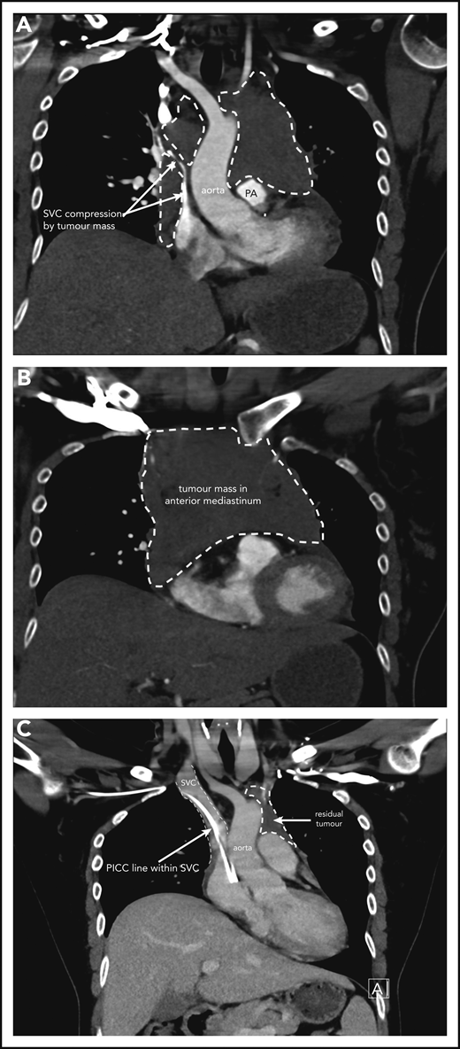 Case 1 of patient with primary mediastinal B-cell lymphoma presenting at 31weeks gestation. (A) Coronal section chest CT scan with contrast at diagnosis, pretreatment. Illustrates significant compression of SVC by tumor mass (within broken lines) on right and demonstrating extent of mass also on left superior to pulmonary artery (PA). (B) Transverse section chest CT scan with contrast at diagnosis, pretreatment. Illustrates extent of anterior mediastinal tumor mass. CT imaging suggested possible moderate-sized pericardial effusion found on echocardiography to be a small effusion. (C) Coronal section chest CT scan with contrast at completion of treatment. Normal caliber SVC with a peripherally inserted central catheter (PICC) line in situ. Small volume of residual tumor (within broken lines). Subsequent PET-CT scan demonstrated no activity confirming a complete metabolic response.