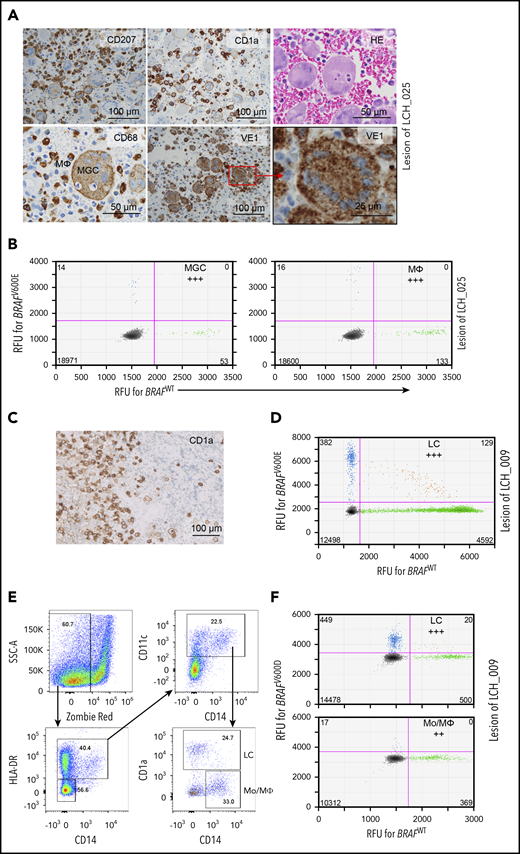 Detection of the BRAF mutation in multiple myeloid cell types isolated from LCH lesions of SS LCH patients. (A) FFPE biopsy taken from the osteolytic lesion in the skull of UFB patient LCH_025. IHC was performed to stain LC-like cells (CD207, CD1a), MGCs, and MΦs (CD68 and morphology). Cells expressing mutant BRAFV600E protein were detected with VE-1 antibody. (B) Detection of the BRAFV600E mutation in MGCs and CD68+ LCs/MΦs microdissected from the skull lesion of patient LCH_025 by ddPCR; (C) IHC depicting CD1a+ LCH cells in the lesion of MFB patient LCH_009. (D) ddPCR 2-dimensional plot depicting BRAFV600D mutation detection in microdissected lesional CD1a+ cells of MFB patient LCH_009. (E) Gating strategy for flow cytometric sorting of HLA-DR+CD14+CD11c+CD1a+ LC-like cells and HLA-DR+CD14+CD11c+CD1a− Mo’s/MΦs from cryopreserved lesional cells of patient LCH_009. (F) Two-dimensional ddPCR plot depicting BRAFV600D mutation detection in sorted LC-like cells and Mo’s/MΦs of patient LCH_009.