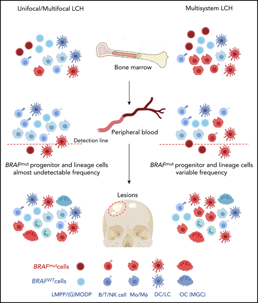 Hypothesis on the cell of origin in high- and low-risk LCH. Based on the results described in this paper, both low-risk (left part) and high-risk (right part) LCH are caused by somatically mutated oligopotent progenitor cells originating in the BM, such as the LMPP or (G)MODP. Progeny formed in the BM and/or at the tissue site that these progenitor cells are recruited to after mobilization into the blood determines the composition of myeloid cell types in the lesion. As shown here and supported by Halbritter et al,8 both high-risk and low-risk LCH lesions may contain the same diversity of mutation-carrying differentiated myeloid cell types, including OCs and MΦs. The different disease manifestations between high- and low-risk LCH may be due to significant differences in the frequencies of mutated progenitor cells and their place in the hematopoietic tree and may be reflected in the frequency and type of mutated end-differentiated cell types present.