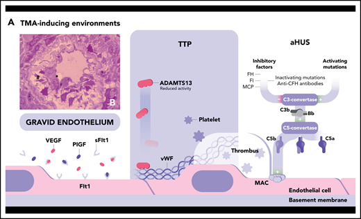 Pathogenic mechanisms of 2 main forms of TMA. (A) TTP is linked to a severe deficiency in ADAMTS13, a metalloproteinase produced by the liver that specifically cleaves the ultralarge multimers of VWF (ULVWF), the most hemostatically active species of VWF. ADAMTS13 deficiency may be acquired (inhibitory autoantibodies directed against ADAMTS13 in immune TTP) or hereditary (recessively inherited biallelic mutations of the encoding gene in hereditary TTP) (Upshaw-Schulman syndrome) (∼3% of cases13). Consequently, ADAMTS13 deficiency leads to the accumulation in the circulation of platelet-hyperadhesive ULVWF multimers with ensuing spontaneous formation of microthrombi within the microcirculation, the fragmentation of red blood cells projected against thrombi, and organ ischemic damage. HUS may be triggered by different mechanisms of endothelial cell injury leading to a common activated prothrombotic phenotype of these cells.1,107 The most frequent forms of HUS are Shiga toxin–producing E coli–associated HUS (STEC-HUS; resulting from Shiga-like toxin–induced endothelial damage) and secondary HUS associated with malignancy, drugs, autoimmune disease, or infection.108 Complement-mediated atypical HUS (aHUS) is linked to a dysregulation of the complement alternative pathway. Alternative C3 convertase, a key enzyme of the alternative pathway composed mainly of C3b and Bb, is in state of continuous low-grade activation. Three main inhibitors tightly control this enzyme: factor H (FH), a circulating protein that attaches to normal endothelial cells, and the membrane-bound membrane-cofactor protein (MCP), which both bind C3b; and factor I (FI), which cleaves C3b. Hyperactivation of the alternative C3 convertase may result from inactivating mutation in FH-, FI-, and MCP-encoding genes or activating mutations in FB- and C3-encoding genes. Uncontrolled activation of the C3 convertase leads to the generation of the C5 convertase and the cleavage of C5 into C5a and C5b. This initiates the formation at the surface of the endothelial cell of the membrane-attack complex (MAC), a cytotoxic multiproteic structure. Complement-induced endothelial cell damage and activation promote thrombi formation and the TMA process. During pregnancy, the occurrence of TMA may be facilitated by the peculiar phenotype of “gravid endothelium,” resulting from the antiangiogenic state characteristic of pregnancy: the relative imbalance between the angiogenic vascular endothelial growth factor (VEGF), the placental growth factor (PlGF), and the antiangiogenic soluble fms-like tyrosine kinase-1 (sFlt1). TMA is the consequence of a phenotype of activated endothelial cell that leads to endothelial cell swelling (*) and detachment (#) from the basement membrane, as shown by light microscopy in the semi-thin kidney biopsy section in panel B (toluidine blue stain; original magnification ×100), and ultimately to thrombosis.