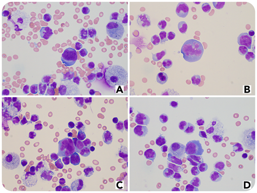 A 39-year-old man treated for a T-cell/histiocyte-rich large B-cell lymphoma–like transformation of nodular lymphocyte-predominant Hodgkin lymphoma with an aggressive and diffuse clinical presentation was hospitalized for fever and aplasia after the fourth cycle of rituximab plus doxorubicin, cyclophosphamide, vindesine, bleomycin, and prednisone. Results of the polymerase chain reaction test routinely performed in the context of pandemic COVID-19 were positive. Initially, there were no severe pulmonary symptoms, and the computed tomography scan showed moderate lung damage. Because persistence of lymphoma was proven based on results of the axillary lymph node biopsy, second-line rituximab, dexamethasone, cytarabine, and cisplatin treatment was initiated.