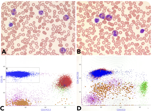 A 27-year-old woman presented with eczema-like lesions. Complete blood counts showed leukocytosis (13 500/μL) and absolute eosinophilia (5260/μL) (panels A-B; original magnification ×100 and ×400, respectively; Wright-Giemsa stain) with 19% lymphocytes. There were no circulating atypical lymphoid cells, blasts, or granulocytic dysplasia in the peripheral smear. Serum tryptase levels were normal, and no lymphadenopathy was found. Flow cytometry of the blood demonstrated an abnormal T-cell population (48% of lymphocytes), with loss of surface CD3 and CD7 expressing CD5, CD4, and CD2 and negative for CD8 (panels C-D, blue population). Genetic studies including fluorescence in situ hybridization and next-generation sequencing were negative for abnormalities in PDGFRA, PDGFRB, FGFR1, JAK2, and BCR/ABL1, excluding myeloid neoplasm-related eosinophilia. An underlying clonal T-cell receptor gene rearrangement was detected and supported the diagnosis of lymphocytic variant of hypereosinophilic syndrome (L-HES). An additional bone marrow biopsy showed <4% blasts with increased eosinophils without abnormal lymphoid infiltrates.