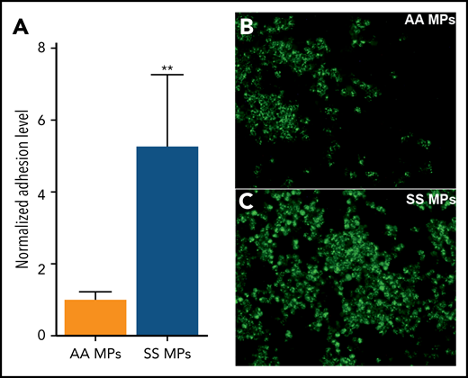 SS MPs increase neutrophil adhesion. (A) SCD neutrophil adhesion level was normalized to the one observed in the AA MP group. Representative photomicrographs taken during the same experiment, in a well in which cells were incubated with a high dose of AA MPs (B) or SS MPs (C) (n = 8 per group) (original magnification ×400). Neutrophils are fluorescently labeled (green). Nuclei of ECs and of neutrophils were labeled using DAPI (data not shown). **P < .01 vs AA MPs, Mann-Whitney U test.