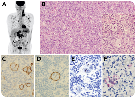 A 69-year-old male human T-cell leukemia virus type 1 (HTLV-1) carrier presented with generalized lymphadenopathy (panel A). Lymph nodes showed scattered Hodgkin and Reed-Sternberg (HRS)–like cells (panel B; hematoxylin and eosin stain, objective 10×; insets, objective 40×). CD30-positive (panel C, objective 40×), CD15-positive (panel D, objective 40×), and fascin-positive HRS-like cells, negative for CD3, CD4, CD5, CD7, CD8, TIA-1, granzyme B, perforin, PAX5, Oct-2, Bob.1, CD68, and Epstein-Barr virus (EBV), were surrounded by small lymphocytes mainly composed of CD4-positive T cells. Surprisingly, in situ hybridization for HBZ, a specific gene product of HTLV-1, showed positive signals only in HRS-like cells (panel E, objective 40×), highlighted by double staining with CD30 (panel F, objective 40×). No clonal T-cell receptor/immunoglobulin gene rearrangements were identified. He received chemotherapy with ABVD (adriamycin, bleomycin, vinblastine, and dacarbazine) and achieved complete remission.