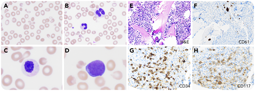A 65-year-old woman undergoing evaluation for a fall had a 2-week history of confusion and weakness. She was found to have fever; subdural hematoma; hemoglobin, 2.8 g/dL; platelet count, 29 × 103/μL; international normalized ratio, 1.2; lactate dehydrogenase, 1600 U/L; creatinine, 1.9 mg/dL; hyperbilirubinemia; elevated fibrinogen; undetectable haptoglobin; and a negative Coombs test. Blood smear showed schistocytes with anisocytosis (panel A; original magnification ×1000; Romanowsky stain), rare dysplastic macropolycytes with abnormal chromatin clumping (panel B; original magnification ×1000; Romanowsky stain), occasional pseudo–Pelger-Huët cells (panel C; original magnification ×4000; Romanowsky stain), and 8% blasts (panel D; original magnification ×4000; Romanowsky stain). The pentad of microangiopathic hemolytic anemia (MAHA), thrombocytopenia, renal insufficiency, encephalopathy, and fever prompted initiation of plasma exchange and corticosteroids for presumptive thrombotic thrombocytopenic purpura (TTP). ADAMTS13 activity was normal. Bone marrow biopsy was hypercellular with left-shifted hematopoiesis and dysplastic erythropoiesis (panel E; original magnification ×200; hematoxylin and eosin stain), dysplastic micromegakaryocytes by CD61 staining (panel F; original magnification ×200), and increased myeloid blasts by CD34 staining (panel G; original magnification ×400) and CD117 staining (panel H; original magnification ×400). Bone marrow and peripheral blood findings were consistent with myelodysplastic syndrome (MDS) with excess blasts 2. Cytogenetics demonstrated a complex karyotype (deletions of 5q, 6q, 12p, and 17p and trisomy 8).
