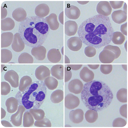 A 73-year-old Wisconsin woman was hospitalized with several days of intermittent fevers and fatigue. A complete blood count revealed pancytopenia with a white blood cell count of 2.4 × 109/L, hemoglobin 12.4 g/dL, platelets 37 × 109/L, and mean corpuscular volume 86 fL. A peripheral smear revealed numerous basophilic dense morulae within the cytoplasm of neutrophils, highly suggestive of anaplasmosis (panels A-D: Wright-Giemsa stain; 100× objective lens; total magnification ×1000). Also noted were pseudo–Pelger-Huët bilobed neutrophils, a phenomenon which is increasingly recognized in cases of anaplasmosis.