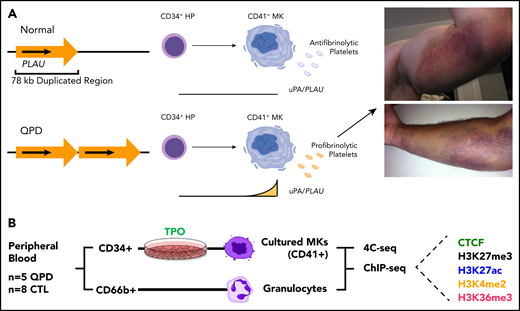 Overview of QPD and study design (A) Overview of QPD pathogenesis. QPD is associated with a duplication mutation of PLAU that selectively increases PLAU expression with megakaryocyte differentiation, resulting in a platelet-dependent gain-of-function defect in fibrinolysis, with hemostatic consequences. Images show QPD bleeds in 2 participants, after exercise (top) or a minor fall (bottom). (B) Overview of samples, cell types, and experimental assays. TPO, thrombopoietin; MK, megakaryocytes; HP, hematopoietic progenitor. The schematic in panel A was created with BioRender.com.