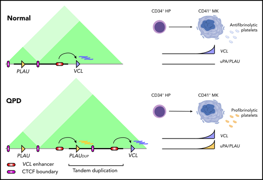 Schematic representation of the interactions across the PLAU locus in nonaffected individuals (normal, top) and in individuals affected by Quebec platelet disorder (QPD, bottom). The different genomic compartments are represented by the pink (sub-TADPLAU) and green box (sub-TADVCL ). The duplicated segments are represented in blue and orange. TAD, topologically associating domain. See Figure 6 in the article by Liang et al that begins on page 2679.