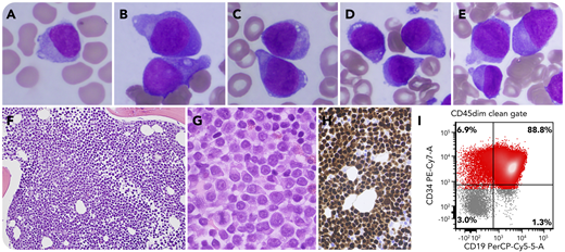 A 65-year-old woman with a history of multiple myeloma, diploid karyotype, in remission 5 years after double autologous stem cell transplant, was on maintenance therapy with elotuzumab and lenalidomide. Upon follow-up, she was found to have pancytopenia with 24% circulating “plasmacytoid” cells (panel A: Wright-Giemsa stain, original magnification ×1000). No paraprotein was detected. Bone marrow evaluation showed a hypercellular marrow replaced by medium-sized plasmacytoid cells, 85% of cellularity, characterized by immature chromatin, prominent nucleoli, and few cytoplasmic vacuoles (panels B-E: Wright-Giemsa stain, original magnification ×1000; panels F-G: hematoxylin and eosin stain, original magnification ×200 and ×1000, respectively). The neoplastic cells expressed PAX-5 and TdT (panel H: original magnification ×400) by immunohistochemistry; they were also CD45dim and expressed CD19, CD22, and CD34 by flow cytometry (panel I). The patient was diagnosed with B acute lymphoblastic leukemia. No aberrant plasma cell population was detected. Conventional karyotyping showed trisomy 8. Mutation profiling revealed 2 TP53 missense mutations, A347T and P177L. Fluorescence in situ hybridization was negative for deletion of the 17p13.1/TP53 locus.