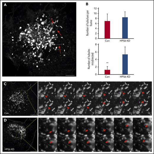 Live cell imaging shows misdirection of endosome-derived transport tubules in endothelial cells lacking BLOC-2. (A) GFP-CD63 expressing HUVECs were analyzed by live-cell spinning-disc confocal microscopy and demonstrate numerous endosome-derived long transport tubules (arrows) and GFP-CD63-labeled mature WPBs. Scale bar represents 5 μm. (B) Bar graphs showing total number of long transport tubules exiting endosomes per cell estimated by analyzing first frame from 8 cells each from 2 separate experiments, and number of tubules directed to the core of the cell in control and BLOC-2–depleted GFP-CD63-expressing HUVECs (**P < .01). (C) Fourfold magnified 0.3-s interval image sequences (1 to 12) are shown from the boxed region in the micrograph of a control cell on the left. A GFP-CD63–positive long transport tubule (red arrows) exits an endosome and ends on a WPB. Scale bar represents 10 μm. (D) Fourfold magnified 0.3-s interval image sequences (1 to 12) are shown from the boxed region in the micrograph of a BLOC-2–depleted cell on the left. A GFP-CD63–positive long transport tubule (red arrows) exits an endosome but is directed centrally to another endosome. Scale bar represents 10 μm.