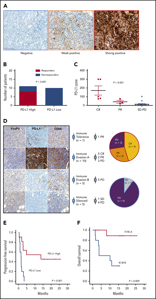 PD-L1 expression and immune subtypes of responders to avelumab. (A) Images of PD-L1–negative, focal weak positive, and diffuse strong positive cases by immunohistochemistry. (B) Comparison of responders and nonresponders based on high and low PD-L1 expression (PD-L1 score >10 vs ≤10). (C) Distribution of PD-L1 scores according to responses. (D) Association of response and immune subtypes: representative immunohistochemistry images of each TIME subgroup. FoxP3-positive regulatory T cells were very abundant in IT but then decreased rapidly. PD-L1 expression was highest in IE-A patients. The CD68-positive macrophages of IS showed a unique morphology of the process type. (E) Progression-free survival of high and low PD-L1 patients. (F) Overall survival of 4 immune subtypes.