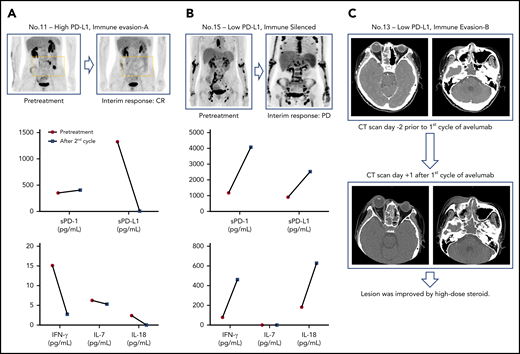 Posttreatment changes of serum cytokines and a case of flare reaction. (A-B) Serial assessment of sPD1 and sPD-L1 and cytokines in patients showing complete response and disease progression. (C) A case of flare reaction occurring immediately after the first dose of avelumab.