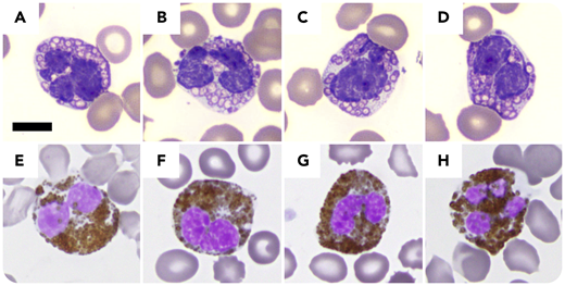 A 72-year-old woman with chronic myelomonocytic leukemia, recently progressed to acute myeloid leukemia and extensive tinea pedis, presented with fever (38.1°C) shortly after a third cycle of decitabine. Workup revealed normocytic anemia (hemoglobin, 6.9 g/dL; mean corpuscular volume, 100 fL), thrombocytopenia (platelets, 16 × 103/µL), leukopenia (white blood cells, 3.7 × 103/µL), neutropenia (0.74 × 103/µL), increased (1-3)-β-d-glucan (309 pg/mL), and normal chest radiograph, lactate, urinalysis, blood culture, and galactomannan. Peripheral blood smear identified 11% neutrophils containing unevenly distributed cytoplasmic spherical forms with peripheral rimming and occasional central dots, which, after a microbiology consultation, were deemed morphologically compatible with intracellular yeast forms of histoplasma (panels A-D: original magnification ×100, Wright-Giemsa stain). Subsequent urine histoplasma antigen was negative. Furthermore, the cytoplasmic “yeast forms” were positive for myeloperoxidase (panels E-H: original magnification ×100, myeloperoxidase stain). Taken together with bone marrow findings of increased blasts and dyspoiesis, the cytoplasmic findings were recognized as markedly dysplastic neutrophilic granules.