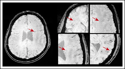 Axial SWI showing CMBs (indicated by the red arrows) in a patient who was diagnosed with ITP at age 10. This patient was 20 years old at the time of MRI and had a disease duration of 118 months and 5 CMBs dispersed throughout the brain.