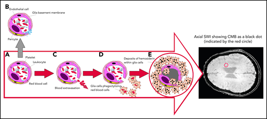 Mechanism of SWI of occult CMBs. Breaks in the exceedingly small blood vessels, like capillaries or postcapillary venules, are followed by extravasation of a thin amount of blood. The wall of these microvessels, made by interconnected endothelial cells, covered by a glia basement membrane with embedded pericytes (A), prevents blood from leaking out. If vessel damage occurs in healthy people, a multilayer of platelets is immediately formed to close the break, avoiding blood extravasation (B). However, if platelets are severely reduced, like in ITP, blood cells can escape and invade the cerebral parenchyma (C), inducing glia cells activation into macrophages that phagocytize escaped cells and degrade the hemoglobin into nontoxic hemosiderin deposits (D), preventing the toxicity of free iron. Hemosiderin-laden macrophages (E) may persist indefinitely. Because of their high iron content, SWI allows the detection of CMBs, that appear as small black dots, as shown in the encircled area of the axial brain representation.