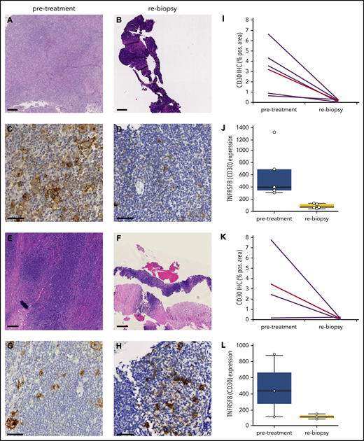 Rapid and (near) complete reduction in HRSCs during anti-PD1 treatment. (A-D) Patient with absence of HRSCs in rebiopsy (A-B, H&E stain; C-D, CD30 stain). (D) At rebiopsy after the start of anti-PD1 therapy, high-magnification images show scattered CD30+ cells resembling small activated immune cells in the tissue but no large HRSCs. (E-H) Patient with maintenance of HRSCs in rebiopsy (E-F, H&E stain; G-H, CD30 stain). Scale bars, 250 µm for H&E staining; 50 µm for CD30 staining. (I-L) WSI and gene expression of CD30 in paired samples. Patients with absence of HRSCs in rebiopsy (I-J) and patients with HRSCs detectable in rebiopsy (K-L). (J,L) Gene expression of TNFRSF8 (CD30) in normalized counts using NanoString technology (P = .0049 for entire cohort, Student t test). (I,K) CD30 immunohistochemically stained area as a percentage of WSI by digital image analysis (P = .0156 for entire cohort, 2-tailed paired Student t test). Red line, mean value.