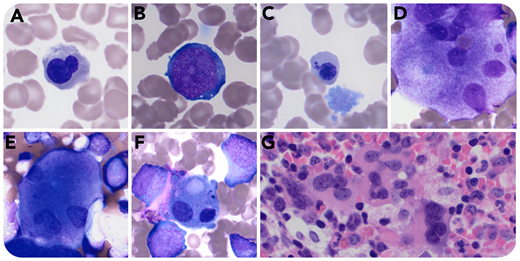 A previously healthy 5-month-old girl was hospitalized for fever (39.6°C) and intermittent tachycardia. Five weeks earlier, her father had tested positive for severe acute respiratory syndrome coronavirus 2 (SARS-CoV-2). She had both SARS-CoV-2 by reverse transcription polymerase chain reaction (nasopharynx) and anti–SARS-CoV-2 immunoglobulin G and was experiencing severe, progressive anemia (6.6 g/dL) and thrombocytopenia (36 × 103/µL) with leukopenia (3.2 × 103/µL). Bone marrow aspirate showed left-shifted granulocytes with reactive changes. A subset (<10%) of erythroblasts demonstrated nuclear lobation (panel A; original magnification ×1000; Jenner-Giemsa stain), irregular nuclear contours and cytoplasmic vacuoles (panel B; original magnification ×1000; Jenner-Giemsa stain), and detached nuclear fragments (panel C; original magnification ×1000; Jenner-Giemsa stain). Few (<10%) megakaryocytes showed separated nuclei (panels D-E; original magnification ×1000; Jenner-Giemsa stain) or micromegakaryocytes (panel F; original magnification ×1000; Jenner-Giemsa stain). Core biopsy was hypercellular, demonstrating increased megakaryocytes with focal clustering (panel G; original magnification ×500; hematoxylin and eosin stain). There was no evidence of hemophagocytic lymphohistiocytosis. Other significant findings included hypoalbuminemia, markedly increased brain natriuretic peptide (3617.5 pg/mL), elevated D-dimer (8.06 µg/mL), and mild to moderate tricuspid valve regurgitation with small pericardial effusion. All symptoms and laboratory findings of multisystem inflammatory syndrome in children (MIS-C) resolved with methylprednisone treatment. The patient remained healthy, with complete recovery of all lineages and no other instances of cytopenia during outpatient follow-up for 6 weeks.