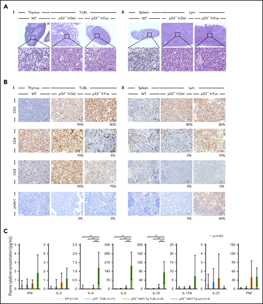Characterization of tumors found in VAV1-mutant p53-null mice. (A) Sections stained by hematoxylin-eosin (HE) for tumors collected from mice of indicated genotypes. (i) Thymuses from indicated mutant mice harboring T-LBL plus control WT mice. (ii) Spleens from indicated mutant mice harboring Lym plus WT mice. Original magnification: ×4; insets, ×100. Scale bars, 20 µm. (B) Immunohistochemical analysis of CD3, CD4, CD8a, and phosphorylated-VAV1 (pVAV1). (i) Thymuses from indicated mutant mice harboring T-LBL or WT mice. (ii) Spleens from indicated mutant mice harboring Lym or WT mice. Original magnification ×40. Scale bars, 20 µm. The percentages at the bottom right corner of figures for both T-LBL and Lym samples indicate the positivity in the tumor cells. (C) Serum cytokines found in blood of tumor-bearing mice of indicated genotypes measured at 16 to 24 weeks as control WT mice. The number of mice analyzed is as follows: WT, n = 13; p53−/− mice bearing T-LBL, n = 11; p53−/−VAV1-Tg mice bearing T-LBL, n = 8; p53−/−VAV1-Tg mice bearing Lym, n = 6. **P < .001.