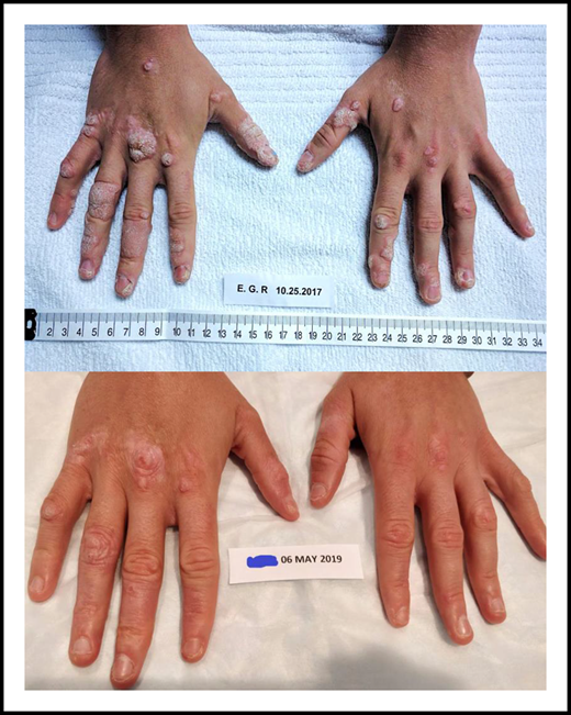 Reductions of warts on the hands of 1 participant in the mavorixafor trial. The upper panel shows the hands prior to start of mavorixafor treatment; the lower panel after completing 18 months of mavorixafor treatment. See Figure 5C-D in the article by Dale et al that begins on page 2994.