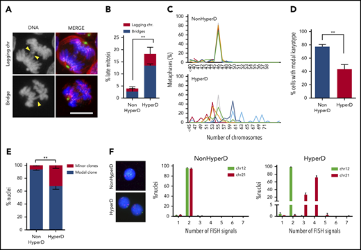 Chromosome-segregation defects and nonmodal karyotypes in HyperD-ALL blasts. (A) Representative DNA (blue)-Kinetochore (purple)-spindle (green and red) IF staining identifying lagging and bridge chromosomes. Yellow arrowheads depict the indicated chromosome-segregation defect. (B) Frequency of blebbistatin-treated mitotic PDX-expanded primary blasts with lagging and bridge chromosomes; n = 151 mitosis from 3 non-HyperD and 96 mitosis from 3 HyperD-ALLs. (C) Comparison of modal karyotypes from 50 metaphases from primary HyperD (n = 6) and non-HyperD (n = 6) B-ALL samples. (D) Frequency of cells showing modal karyotype. (E-F) FISH analysis using DNA probes for chromosomes 12 (green) and 21 (red) of 200 interphase nuclei from n = 3 non-HyperD and 4 HyperD-ALL primary samples. (E) Frequency of cells representing the modal clone vs minor clones. (F) Representative FISH analysis for a primary non-HyperD and a HyperD-ALL. Graphs represent the mean and error bars represent the standard error of the mean. *P < .05, **P < .01; ***P < .0001 (2-way ANOVA). Scale bars, 10 µm.