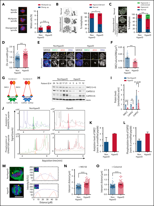 HyperD-ALL blasts show chromosome hypocondensation, loss of centromere stiffness, and defects in the condensin complex. (A) Analysis of spindle abnormalities in B-ALL primary blasts. Left, representative DNA-Kinetochore-spindle IF staining of mitotic cells with bipolar, multipolar, and disorganized spindles. Right, frequency of mitotic cells displaying spindle defects; n = 3 non-HyperD-ALLs (n = 251 mitosis) and n = 3 HyperD-ALLs (n = 251 mitosis) PDX-expanded samples. (B) Frequency of metaphases with hypocondensed chromosomes in primary B-ALL blasts; n = 200 metaphases from 4 non-HyperD and n = 250 metaphases from 5 HyperD-ALLs primary samples. Left, representative images of normal and hypocondensed metaphase chromosomes. Insets represent ×3 magnifications. (C) Chromosome structure of formaldehyde-crosslinked PDX-expanded B-ALL samples. Left, Representative images of metaphase cells with hypocondensed chromosomes. Anti-ACA staining is shown in green. Right, frequency of formaldehyde-crosslinked metaphases showing hypocondensed or hypocondensed with unstructured chromosomes in B-ALL primary samples; n = 60 metaphases from 3 non-HyperD and n = 57 metaphases from 3 HyperD-ALLs. (D) Chromosome arm width using PDX-expanded B-ALL samples from panel C; n = 191 chromosomes from 3 non-HyperD and n = 143 chromosomes from 3 HyperD-ALLs. (E) Representative IF images of metaphase PDX-expanded B-ALL blasts stained with DAPI, anti-SMC2, and anti-ACA. (F) Quantification of the SMC2 total volume in metaphase chromosomes from panel E; n = 30 metaphases from 3 non-HyperD and 3 HyperD-ALLs. (G) Schematic cartoon of the 2 human condensin complexes. (H) WB analysis of the indicated condensin members in whole-cell lysates from PDX-expanded B-ALL samples. (I) Quantification of WB bands from panel H normalized to actin. (J) Representative HPLC-ESI-MS chromatograms of the indicated peptides for HyperD and non-HyperD PDX-expanded B-ALLs. (K) Acetylation levels of SMC2 peptide SQAASILTK (m/z = 480.8). (L) Phosphorylation levels of CAPD2 peptide GPAASTQEK (m/z = 524.7). Results depict the average of the peak areas from independent MS experiments from 2 non-HyperD and 2 HyperD-ALL PDX-expanded blasts. (M) Representative line-scan measurements of individual centromeres in the indicated B-ALL primary samples. DAPI and ACA are depicted as a blue and red lines, respectively. Yellow arrowheads point to the analyzed chromosome. (N) Intercentromeric distance from MG132-treated PDX-expanded B-ALL blasts; n = 155 centromeres from 3 non-HyperD and n = 119 centromeres from 3 HyperD-ALLs. (O) Intercentromeric distance from colcemid-treated PDX-expanded B-ALL blasts; n = 130 centromeres from 3 non-HyperD and n = 111 centromeres from 3 HyperD-ALLs. Graphs represent the mean, and error bars represent the standard error of the mean. *P < .05, **P < .01; ***P < .001; ****P < .0001. Two-way ANOVA (A-C) or Student t test (D, F, I, N, O). Scale bars, 10 µm.