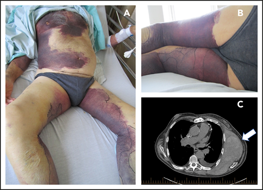 Common forms of bleeding in AHA. Extensive bruising (A), often accompanied by large subcutaneous hematomas (right thigh) (B) that are debilitating because they are associated with anemia, pain, and decreased mobility. (C) Large deeper hematoma of thoracic wall muscles (arrow). Iliopsoas muscle hematomas are also not uncommon.