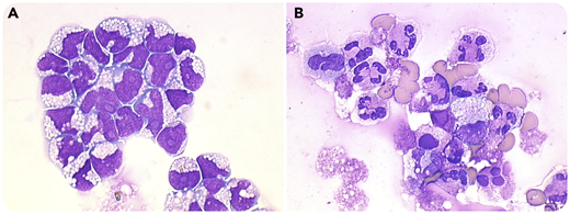A 70-year-old frail woman was evaluated for severe headaches and dizziness. Her previous therapy with imatinib and low-intensity chemotherapy for Philadelphia chromosome–positive acute lymphoblastic leukemia (Ph+ ALL) was truncated because of infections. Complete blood counts were normal (hemoglobin, 125 g/L; leukocytes, 4.43 × 109/L, platelets, 219 × 109/L), but examination of bone marrow (BM) and cerebrospinal fluid (CSF) revealed a relapse, with 2% lymphoblasts in the BM and 2800 cells per μL in CSF, including 93% lymphoblasts (panel A; May-Grünwald Giemsa stain, ×100 oil objective, total magnification ×1000). Those findings were corroborated by both flow cytometric and molecular analysis. Intrathecal treatment consisted of methotrexate, cytarabine, and methylprednisolone, every other day over a 2-week period. CSF clearance of the lymphoblasts and resolution of neurologic symptoms occurred after the first injection. Surprisingly, after 3 injections, the patient experienced mild headaches without fever or nuchal rigidity. CSF analysis showed 710 cells per μL, mostly neutrophils (panel B; May-Grünwald Giemsa stain, ×100 oil objective, total magnification ×1000) with normal CSF proteins (280 mg/L) and glucose (4.0 mmol/L). Infectious meningitis was ruled out after repeated microbiologic examinations of the CSF (direct examination, Gram stain, culture, multiplex polymerase chain reaction). Intrathecal chemotherapy was therefore implicated.