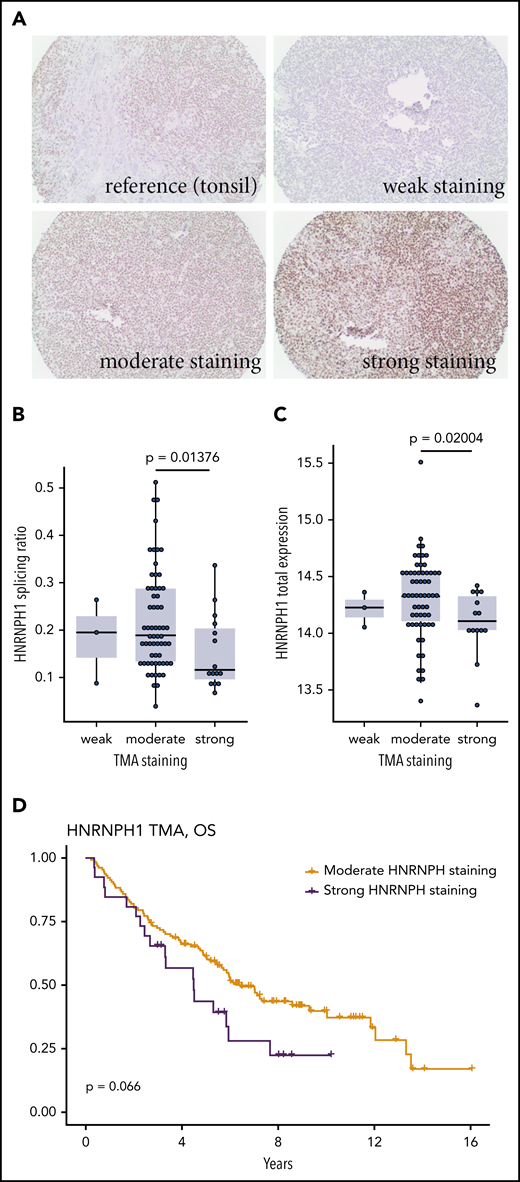 Evaluating HNRNPH expression by tissue microarray. (A) Reactive tonsil tissue stained for HNRNPH expression was used as the reference. Representative images of tumor cores scored as weak (0), moderate (1), or strong (2) HNRNPH staining. (B) Based on the tissues on this tissue microarray with available RNA-seq data (n = 79), higher intensity of HNRNPH staining was associated with a lower splice ratio or a relatively lower proportion of alternative (unproductive transcripts; P = .01376, Wilcoxon rank sum). (C) For the same cases as in panel B, cases with higher intensity staining did not have higher levels of HNRNPH1 mRNA based on normalized read counts. In contrast, cases with high-intensity staining were associated with lower HNRNPH1 expression (P = .02004; Wilcoxon rank sum). (D) Stratification of patients by moderate or strong HNRNPH staining did not show a significant association with OS, but there was a trend toward inferior outcomes.